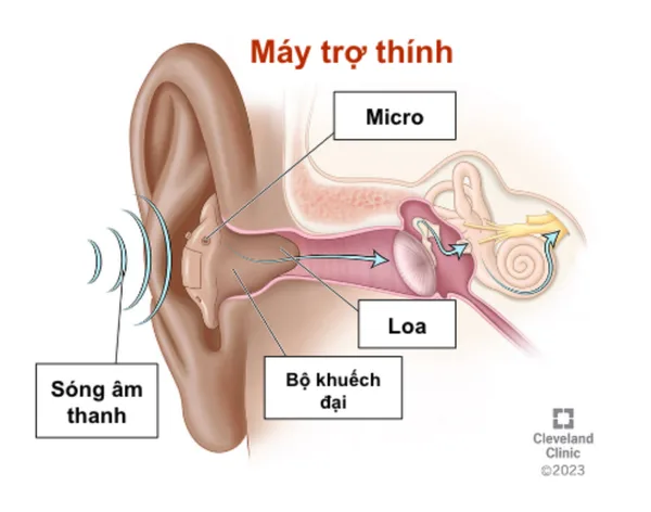 hình ảnh cách máy trợ thính hoạt động