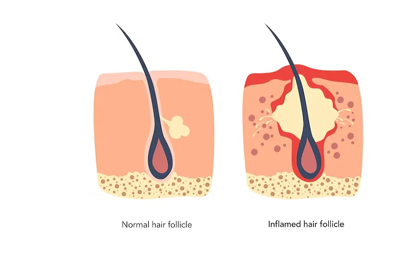 Gây Viêm Mạn Tính Và Giảm Dưỡng Chất Cho Nang Tóc