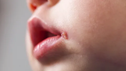 Herpes miệng